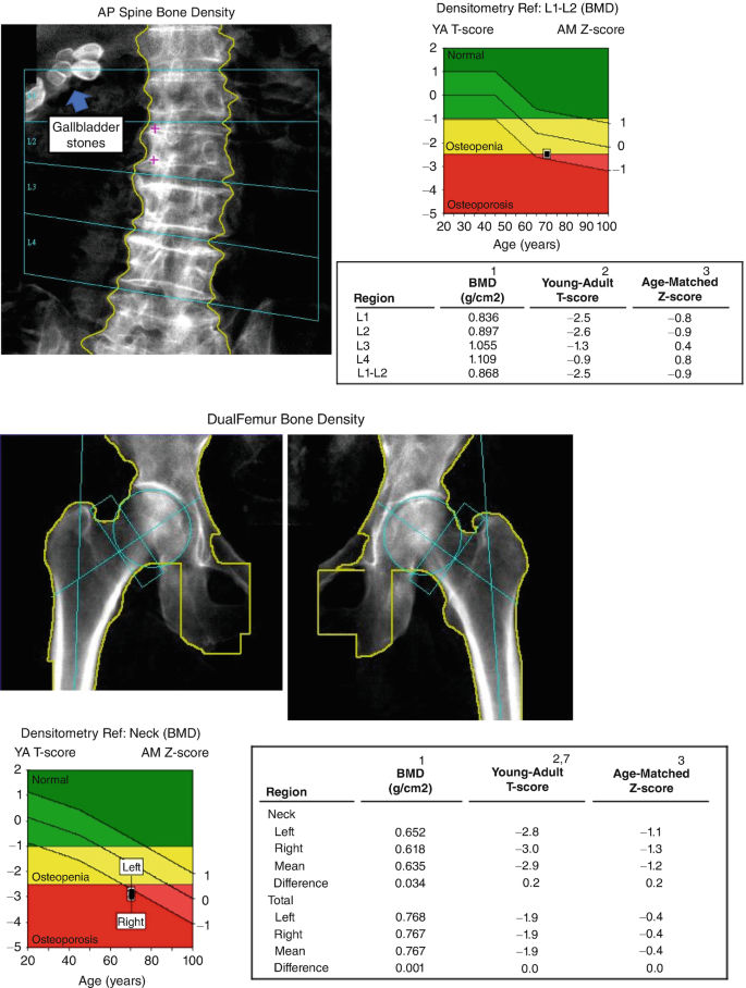 Common Extraskeletal Findings on DXA Studies | Springer Nature Link