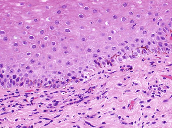 Melanocytic Tumors, Pathology of the Vulva | Springer Nature Link