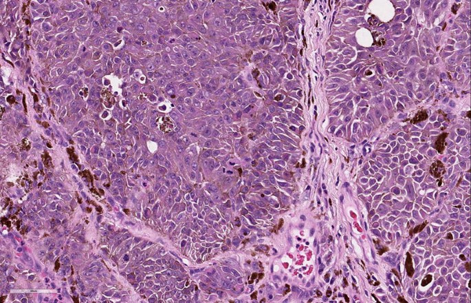 melanotic macule pathology Pathology Outlines main image 1