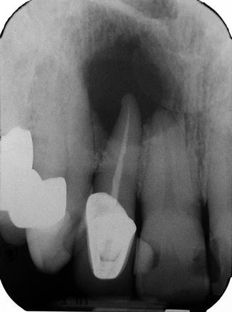 Cyst, Radicular | SpringerLink