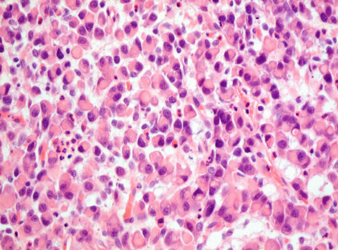 Microscopic image (photomicrograph) of a poorly differentiated gastric  mucinous adenocarcinoma (stomach cancer), signet ring cell type. Tumor cells  have appearance of a traditional signet ring. Stock Photo | Adobe Stock