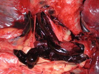Vascular Inflammation - Dr Qaisar Ahmed