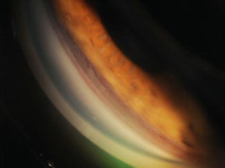 Angle Recession Glaucoma | SpringerLink