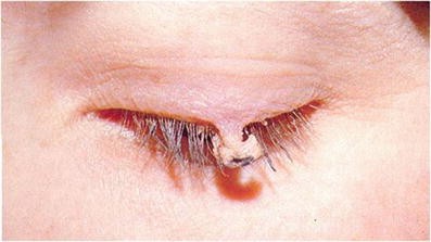 Squamous Cell Papillomas of Eyelid | SpringerLink