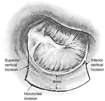 Stapedectomy: Definition, Surgery, Procedure & Recovery