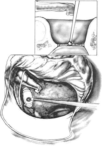 Stapedectomy Surgery for Otosclerosis - Ear Doctor Los Angeles, CA