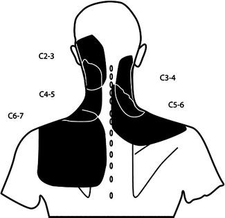 Somatic Referred Pain | Springer Nature Link