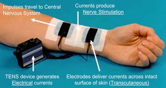 Transcutaneous Electric Nerve Stimulation (TENS) for Arthritis Pain
