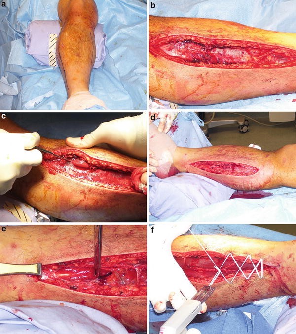 Compartment Syndrome of the Leg