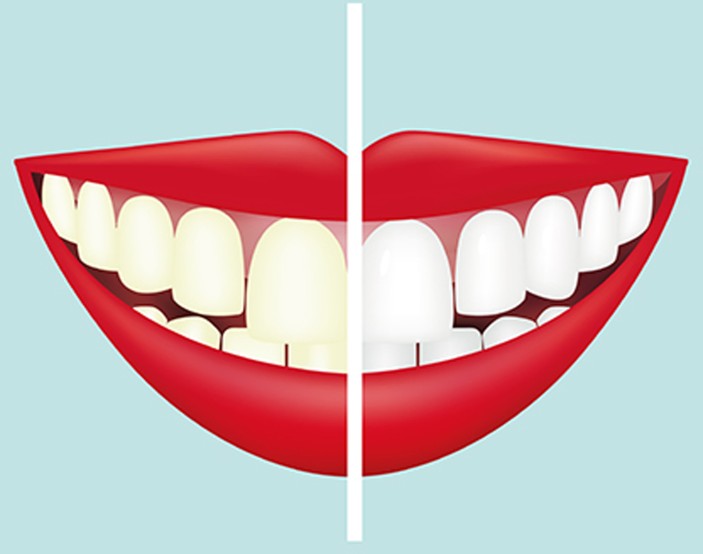 Tooth whitening versus stain removal | BDJ Team
