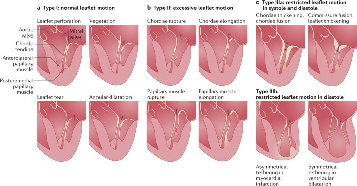 Hypokinesis, Mitral Regurgitation, Aortic Insufficiency 