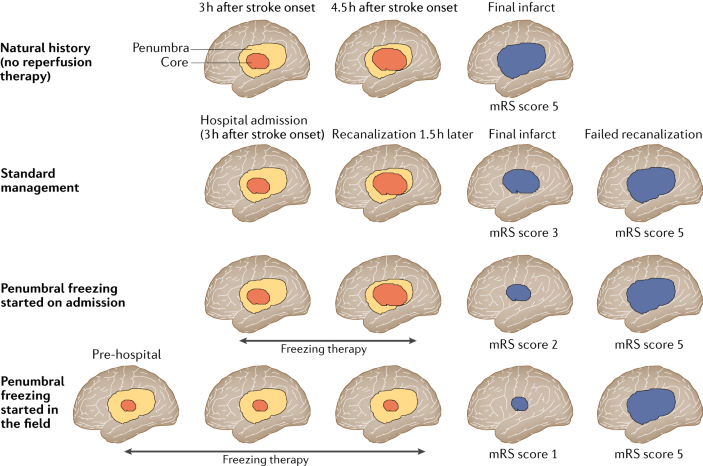 Protecting the ischaemic penumbra as an adjunct to ...