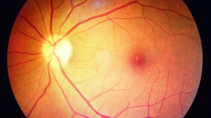 diabetes retinopathy © koolsabuy / stock.adobe.com