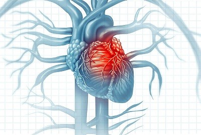 Cardiovascular Diseases © freshidea / stock.adobe.com