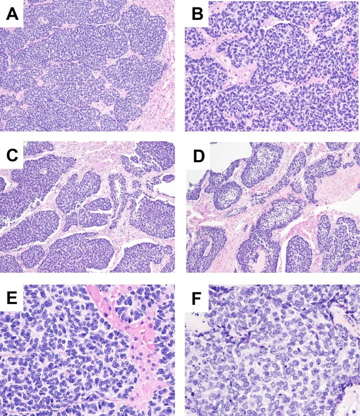 Tumour nests, Figure 3 from featured article