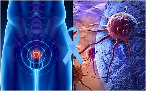 Spotlight On Prostate Cancer