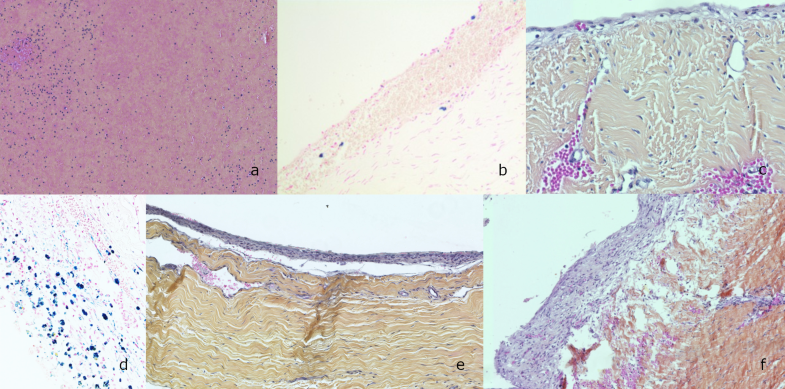 dating subdural hemorrhage dating subdural hemorrhage