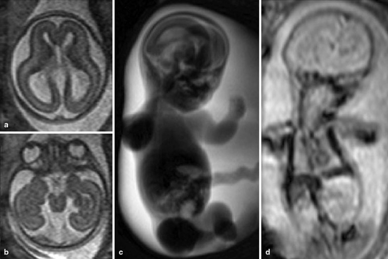 MRI of the Fetal Brain | SpringerLink