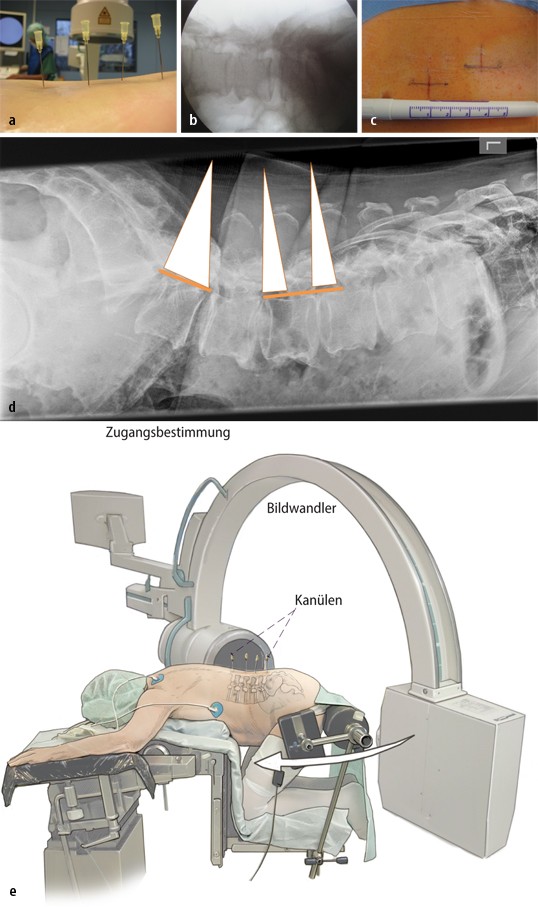 Selektive, mikrochirurgische „Crossover“Dekompression mehrsegmentaler lumbaler Spinalstenosen