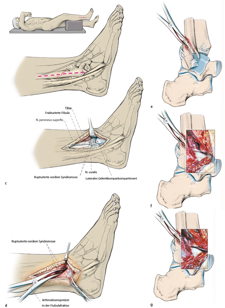 Therapie der Sprunggelenksluxationsfrakturen vom Pronationstyp ...