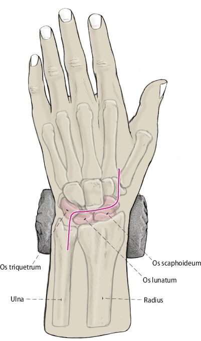 Die Entfernung der proximalen Handwurzelreihe | SpringerLink