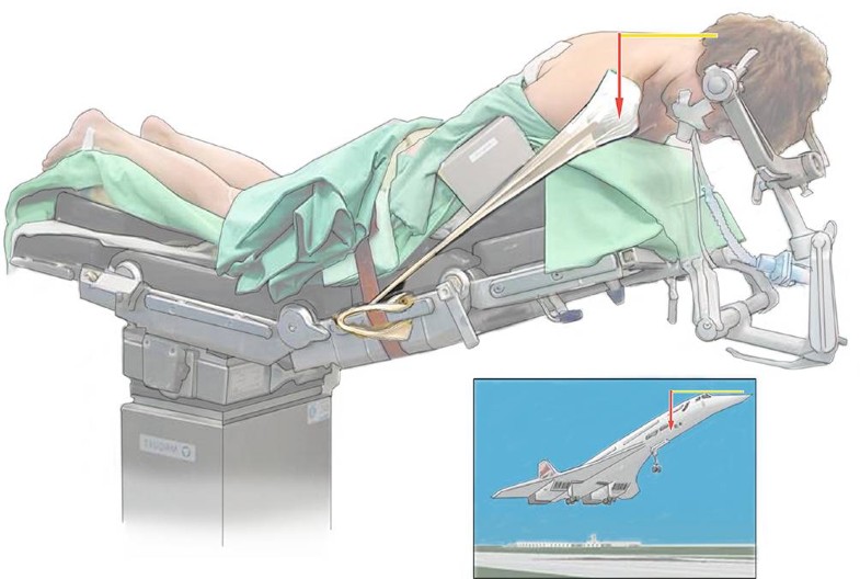 Dorsale Stabilisation der Halswirbelkörper HWK1/HWK2 modifiziert nach