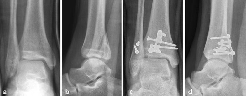 icd 10 lateral malleolus fracture icd 10 lateral malleolus fracture