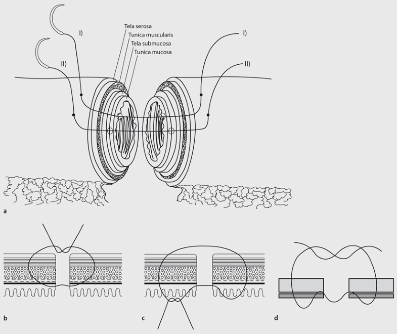 Anastomosentechniken am GastrointestinaItrakt SpringerLink
