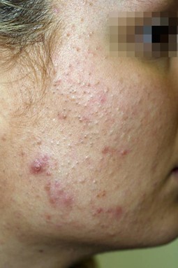 Acne Tarda | SpringerLink