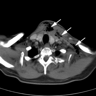 Nekrotisierende Fasziitis bei Peritonsillarabszess SpringerLink