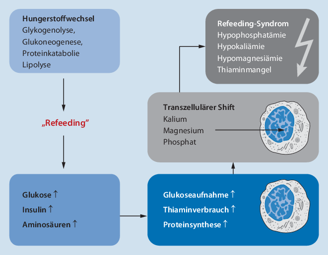 RefeedingSyndrom SpringerLink