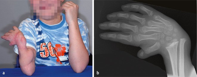 Kompartmentsyndrom Der Oberen Extremität Beim Neugeborenen | SpringerLink