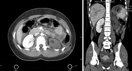 Stumpfes Bauchtrauma Wie Lange Beobachten