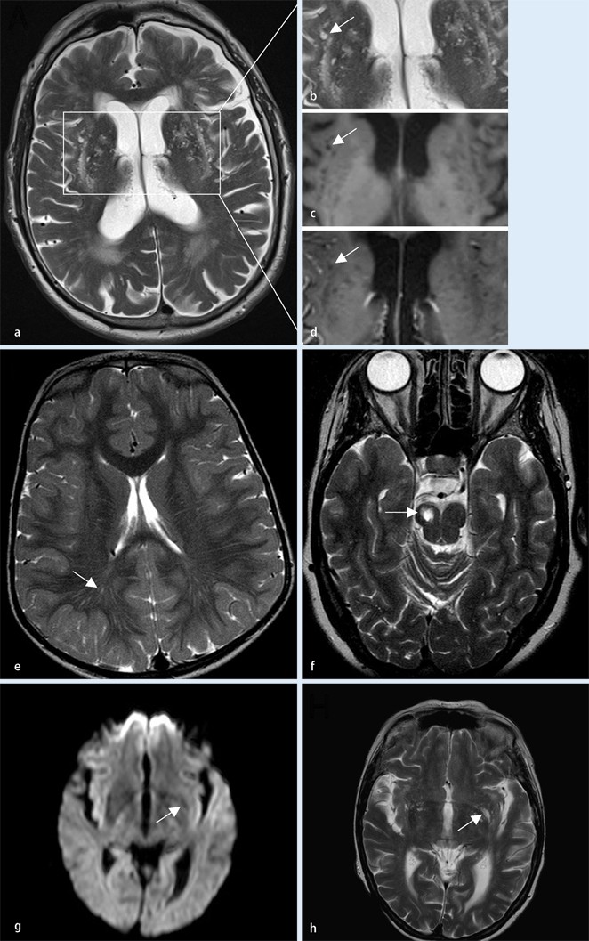 Klinische Bedeutung Normaler Und Erweiterter Virchow Robin Räume