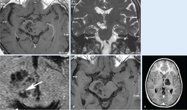 Klinische Bedeutung Normaler Und Erweiterter Virchow Robin Räume Klinische Bedeutung normaler und erweiterter Virchow-Robin-Räume