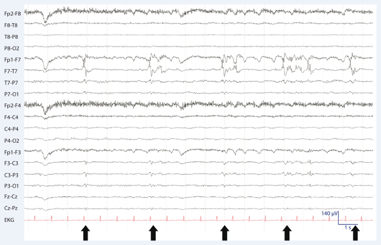 Bedeutung des EEG in der Epilepsiediagnostik