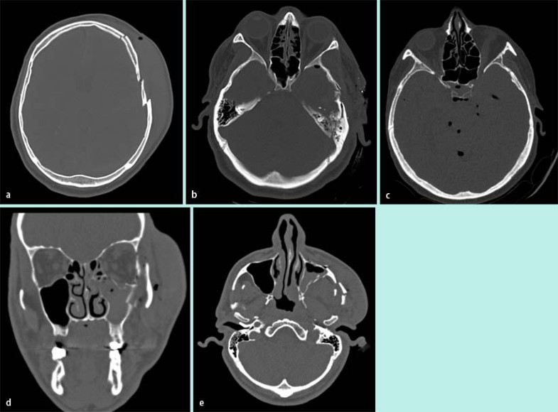 Schädel Hirn Trauma Grad 3 Prognose rd.springer.com