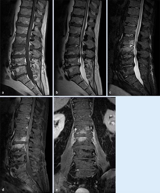 Spondylodiszitis SpringerLink