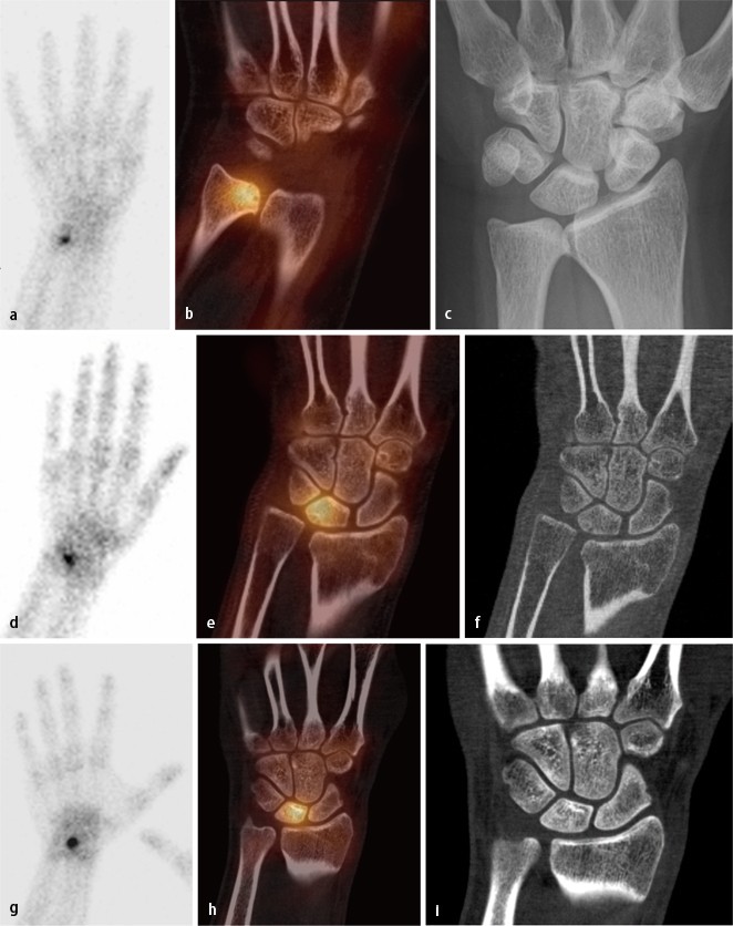 SPECT/CT in der Handgelenkdiagnostik | SpringerLink