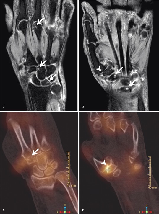 SPECT/CT in der Handgelenkdiagnostik | SpringerLink