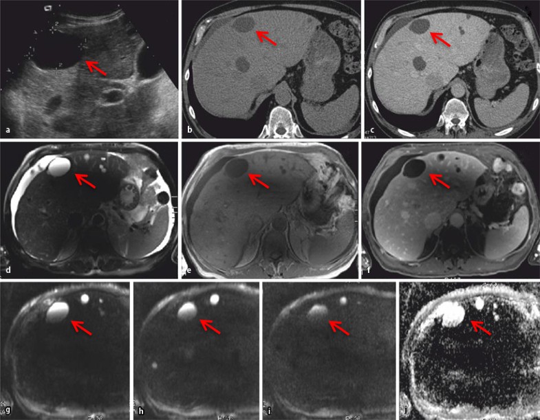 Moderne Diagnostik zystischer Leberläsionen und Hämangiome SpringerLink