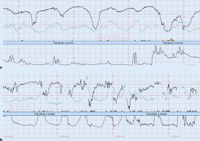 Intrapartales Kardiotokogramm SpringerLink Intrapartales Kardiotokogramm SpringerLink
