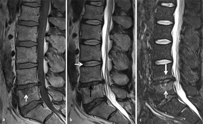 Arthrose Mrt Bilder Lws Entzündung rd.springer.com