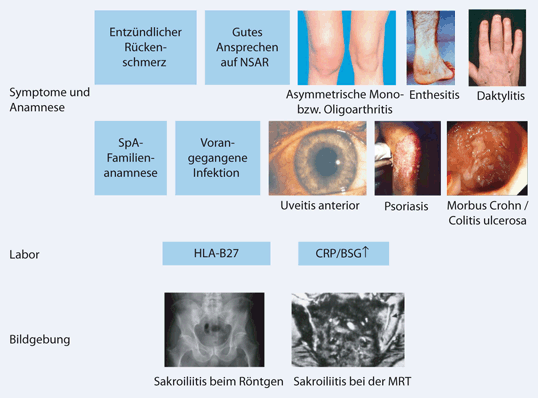 Diagnose und Therapie der axialen Spondyloarthritis einschließlich des