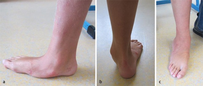 Spastische Fußdeformitäten im Kindesalter | SpringerLink