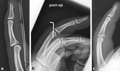 Ligamentäre Verletzungen und Bandinstabilitäten der ...