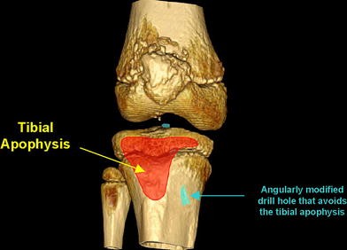 The anatomy of the proximal tibia in pediatric and adolescent patients ...