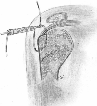 Transosseous Arthroscopic Repair Of Partial Articular-surface 