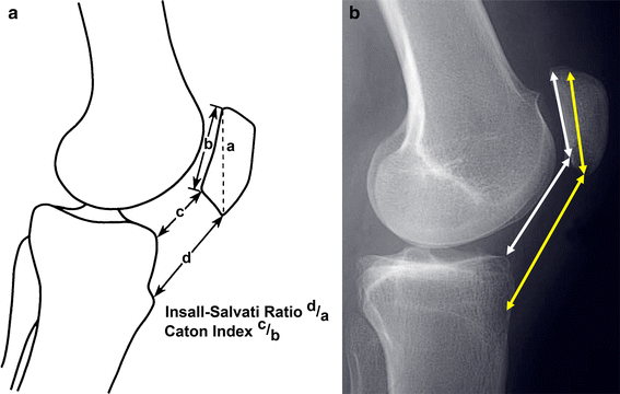 Patella instability: building bridges across the ocean a historic ...