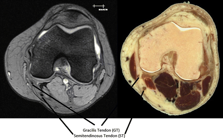 Using pre-operative MRI to predict intraoperative hamstring graft size ...